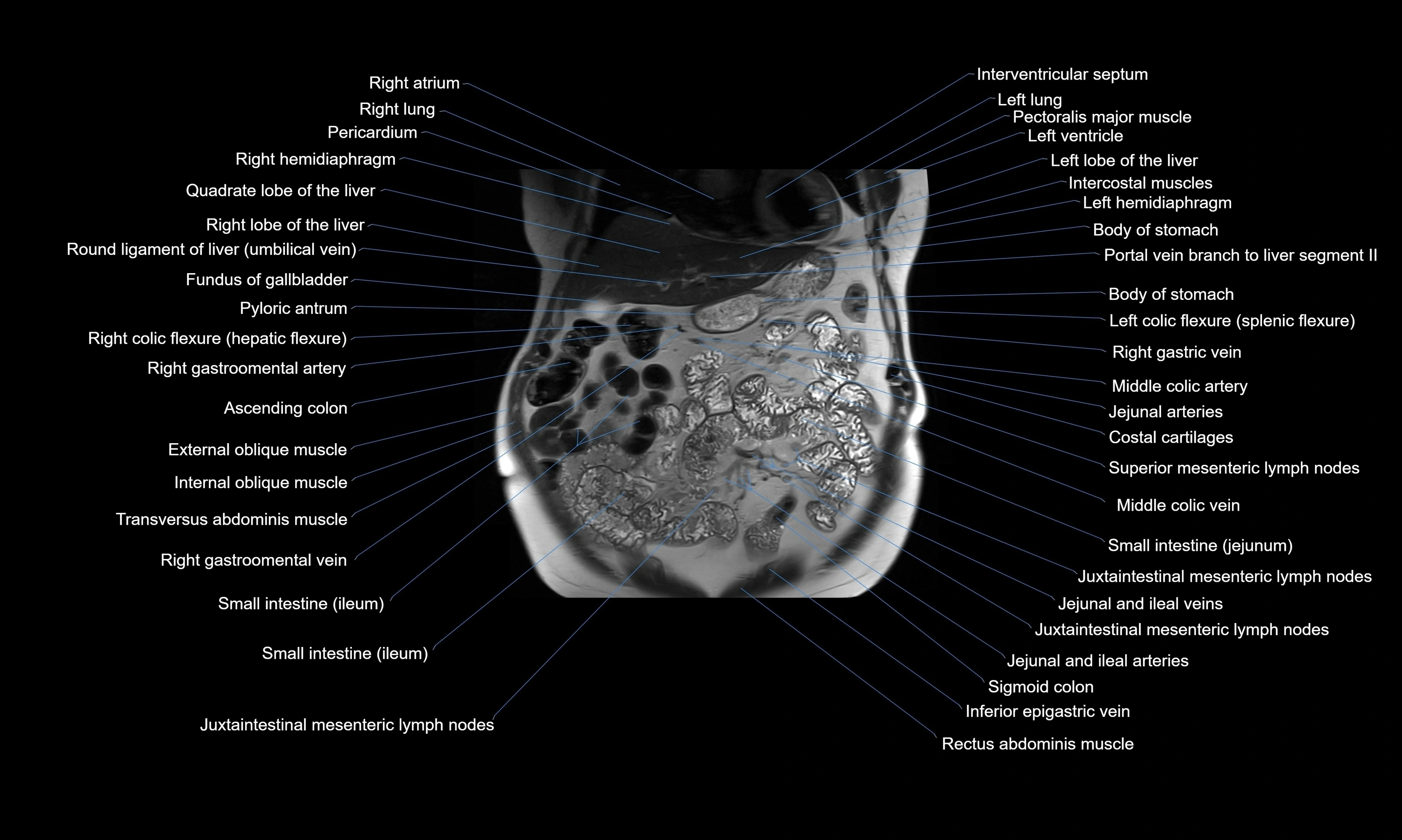 MRI Abdomen axial cross sectional anatomy radiology  image-img-00001-00018.webp